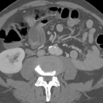 Saccular aortic aneurysm