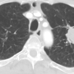 Patient with haemoptysis