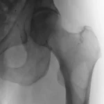 Swift Ninja Catheter: Does what it says on the tin