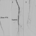 Thrombolysis of bypass graft